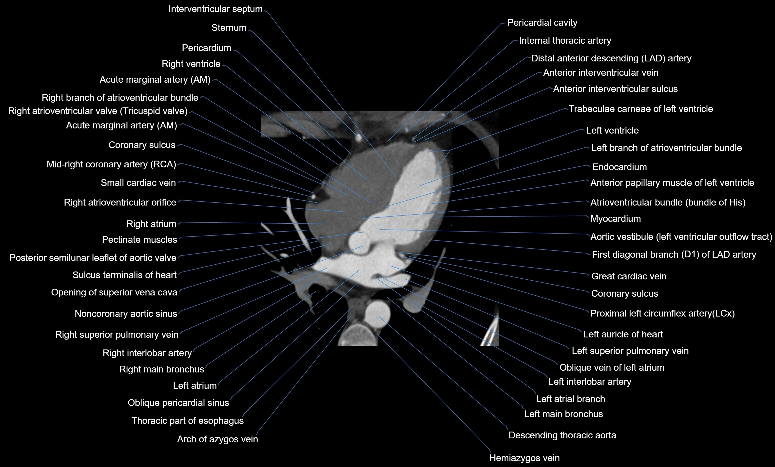 CT heart (coronary angiogram) four chamber view  cross sectional anatomy labelled radiology image -00026.webp
